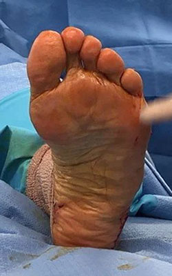 Post Fat Pad Atrophy treatment