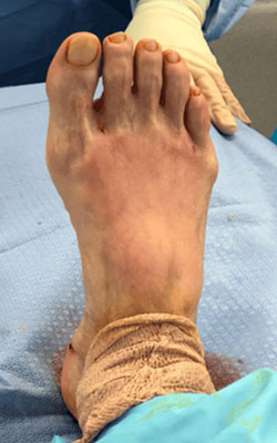 Post Fat Pad Atrophy treatment