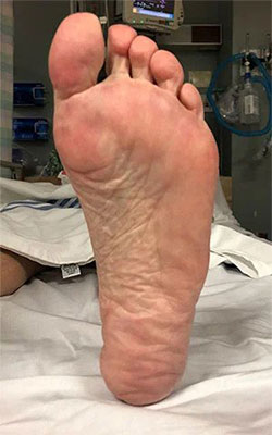 Pre Fat Pad Atrophy treatment