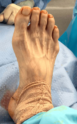 Pre Fat Pad Atrophy treatment