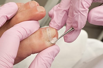 Ingrown toenail specialist in the Palm Beach County, FL: Boynton Beach (Kings Point, Westgate, Delray Beach, Boca Raton, Manalapan, Greenacres, Palm Springs) and Palm Beach Gardens (Juno Beach, Lake Park, Riviera Beach, Jupiter, Tequesta, Mangonia Park, Cloud Lake, Limestone Creek, Cabana Colony), and West Palm Beach (Hypoluxo, Wellington, Haverhill, Loxahatchee Groves, Lake Worth, Lantana, Golden Lakes) areas