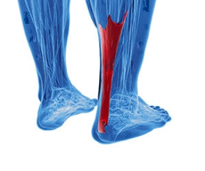 Causes of Achilles Tendonitis