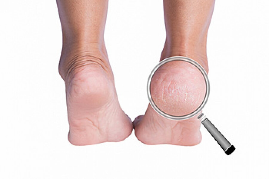 Why do some people get cracks in the skin of their heels and big toes? -  Quora