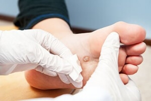 Risk Factors and Treatment of Plantar Warts