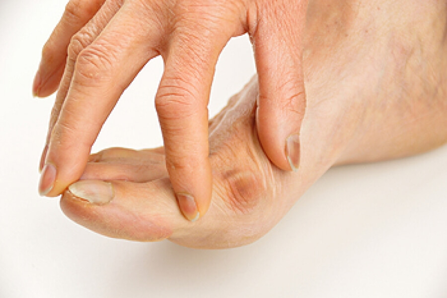 What Is a Bunion?